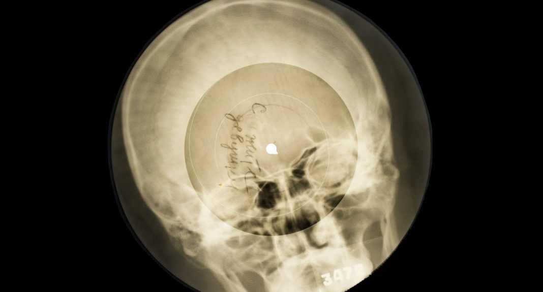 bone record made ou of x-ray