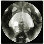 hips x ray becam a bone record in ussr