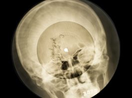 bone record made ou of x-ray